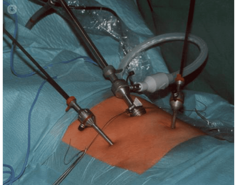 Laparoscopic Hernia Surgery AMI Multi Specialty Hospital