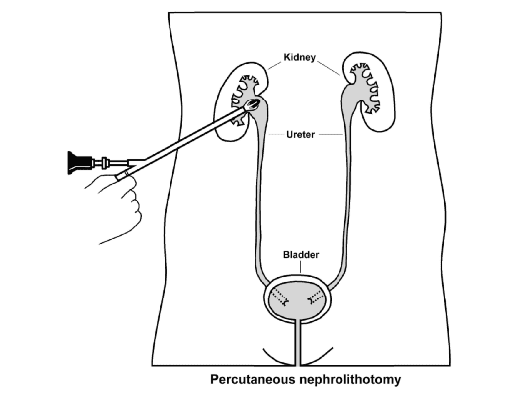 Laser Surgery Kidney Stone (PCNL) AMI Multi Specialty Hospital